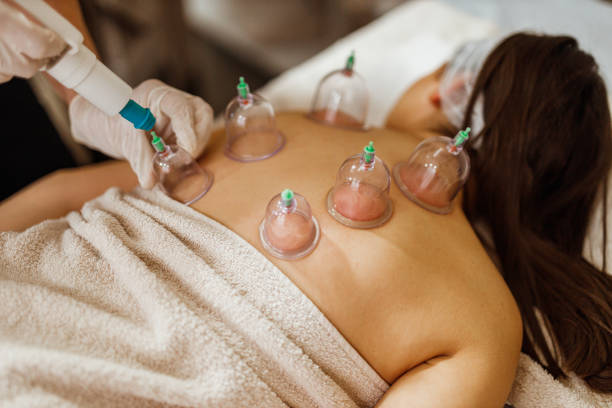 Cupping Therapy1