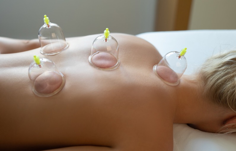 Cupping Therapy3