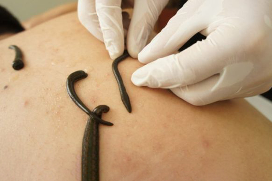 Leech Therapy1