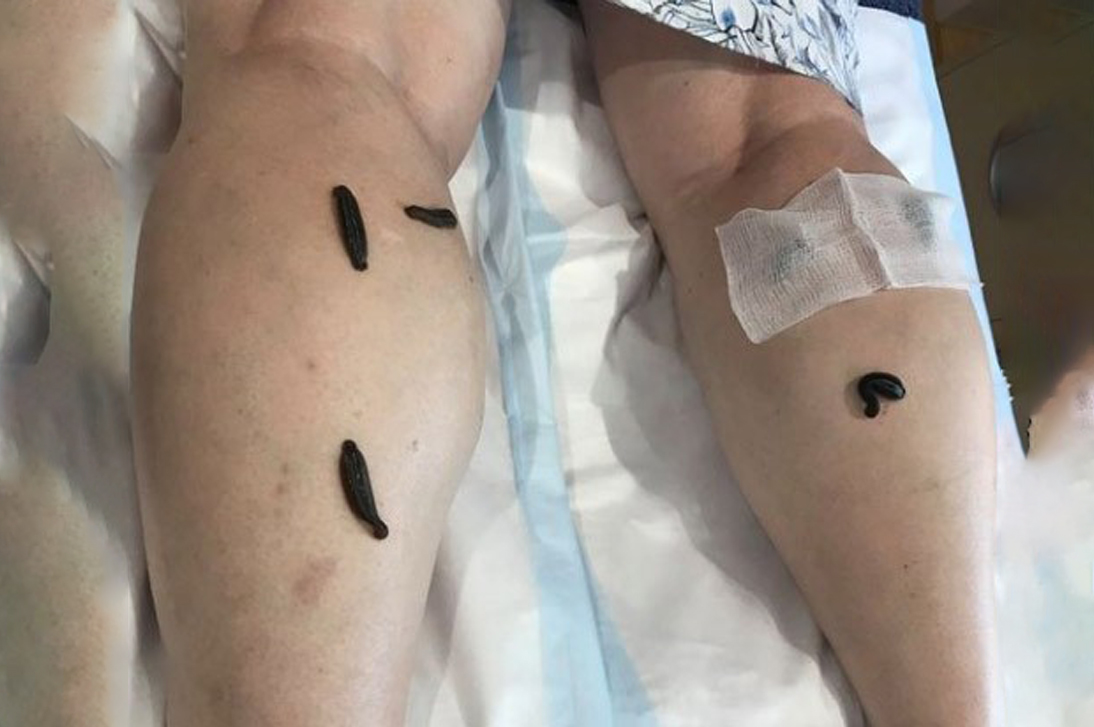 Leech Therapy3