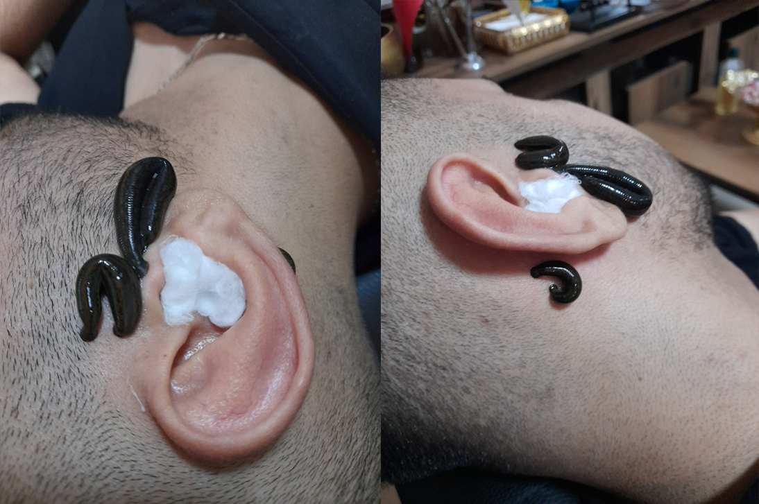 Leech Therapy4