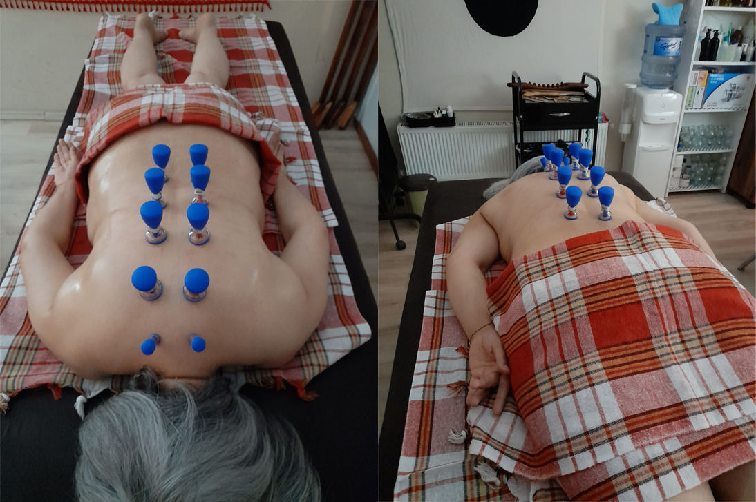 Magnetic cup Therapy3