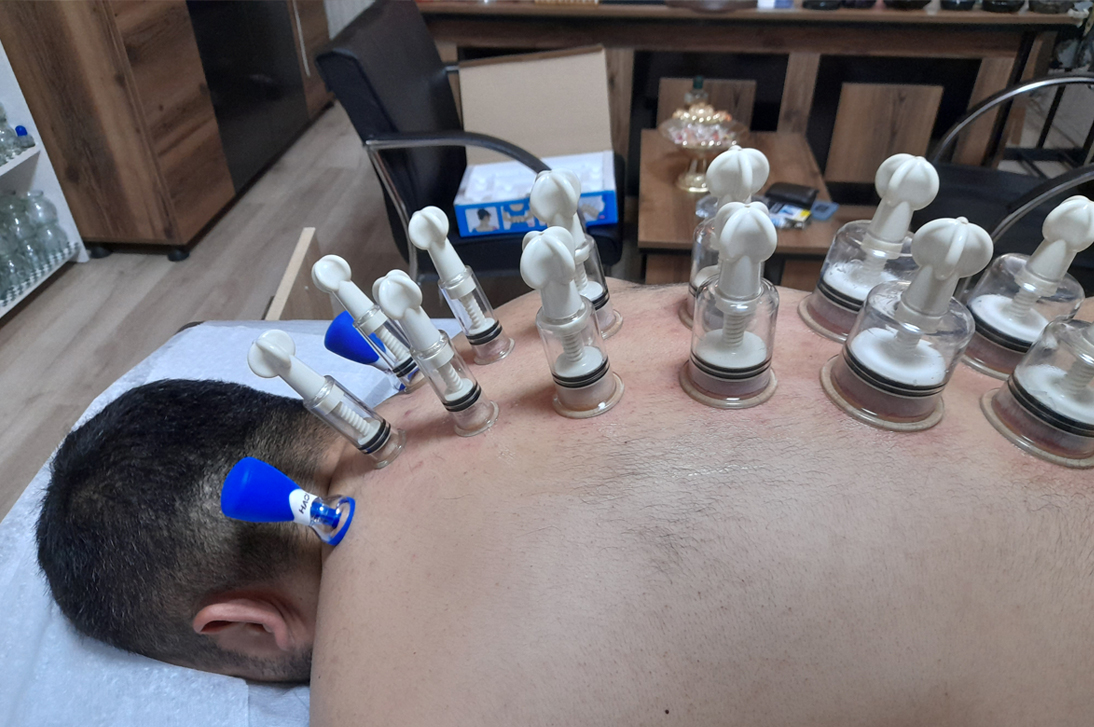 Magnetic-cup-Therapy5